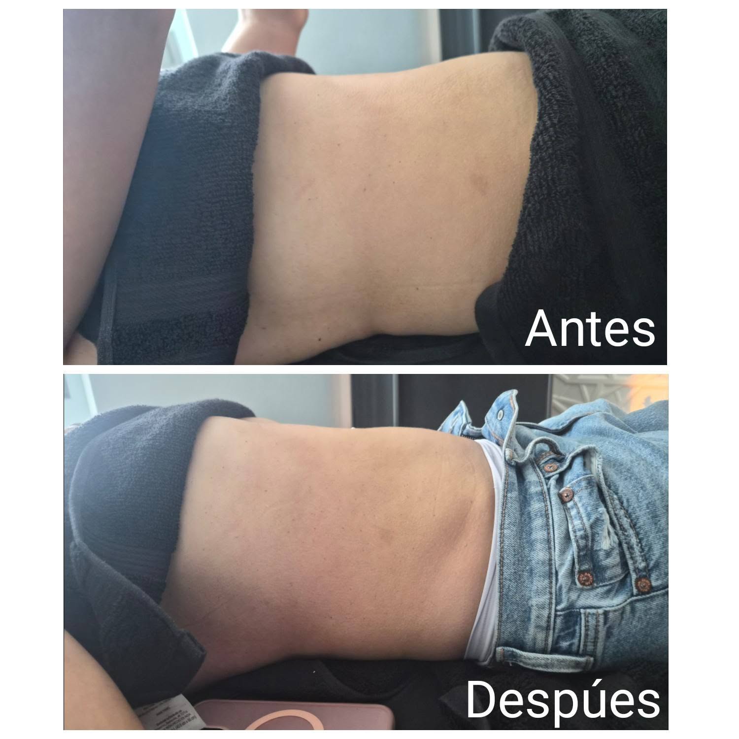Resultado antes y después de tratamiento corporal