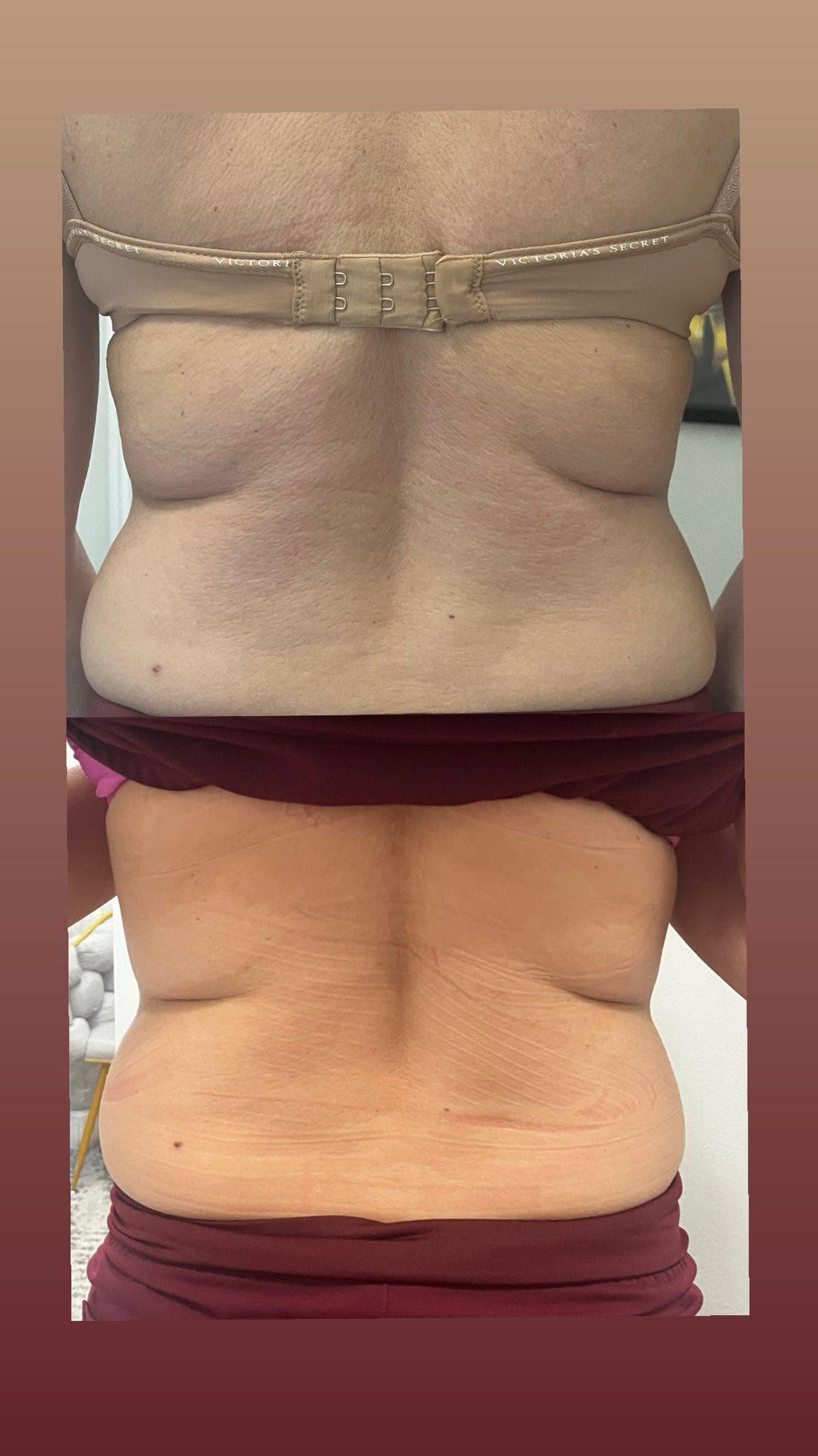 Resultado antes y después de maderoterapia en espalda