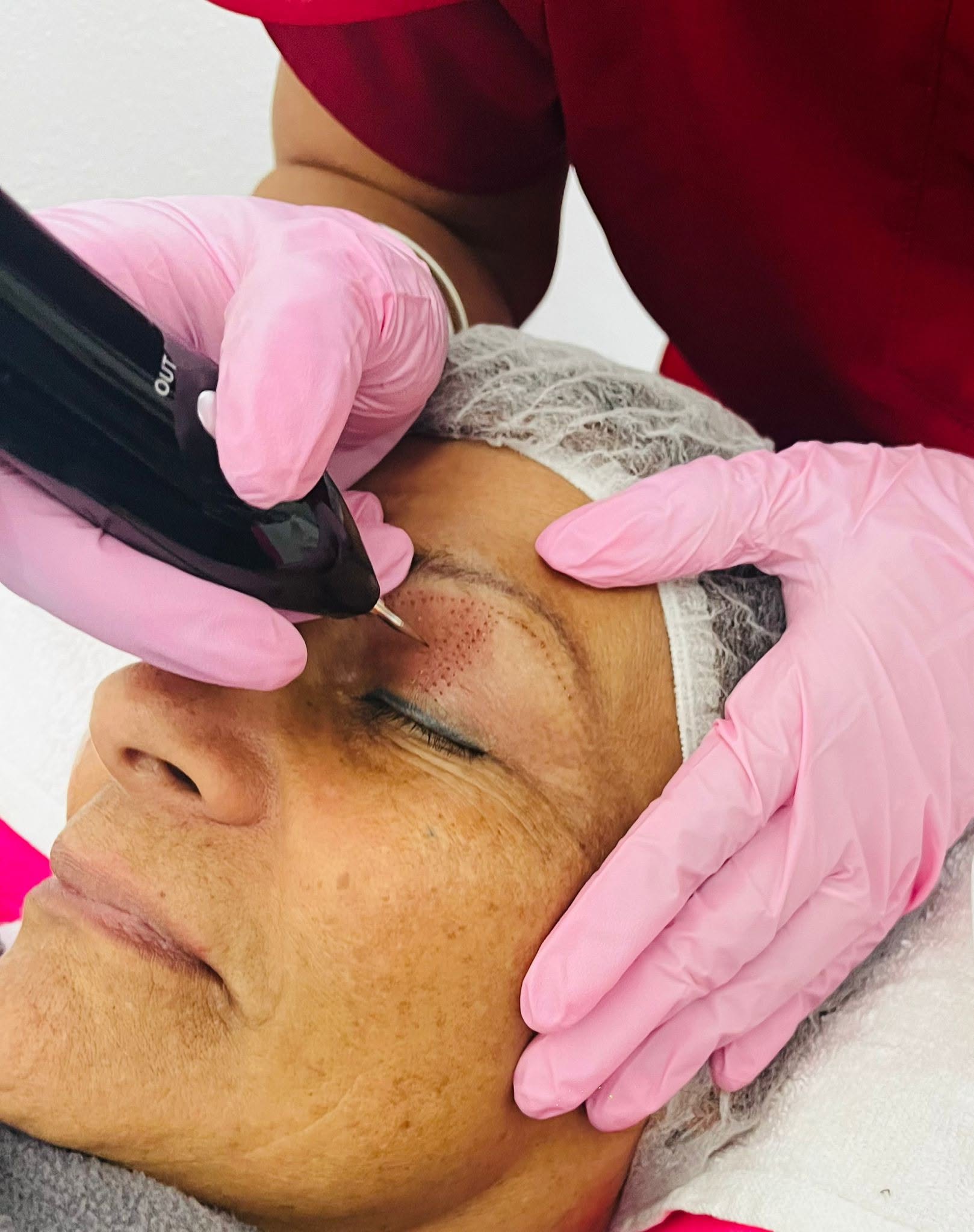 Tratamiento de fibroblasto facial en progreso