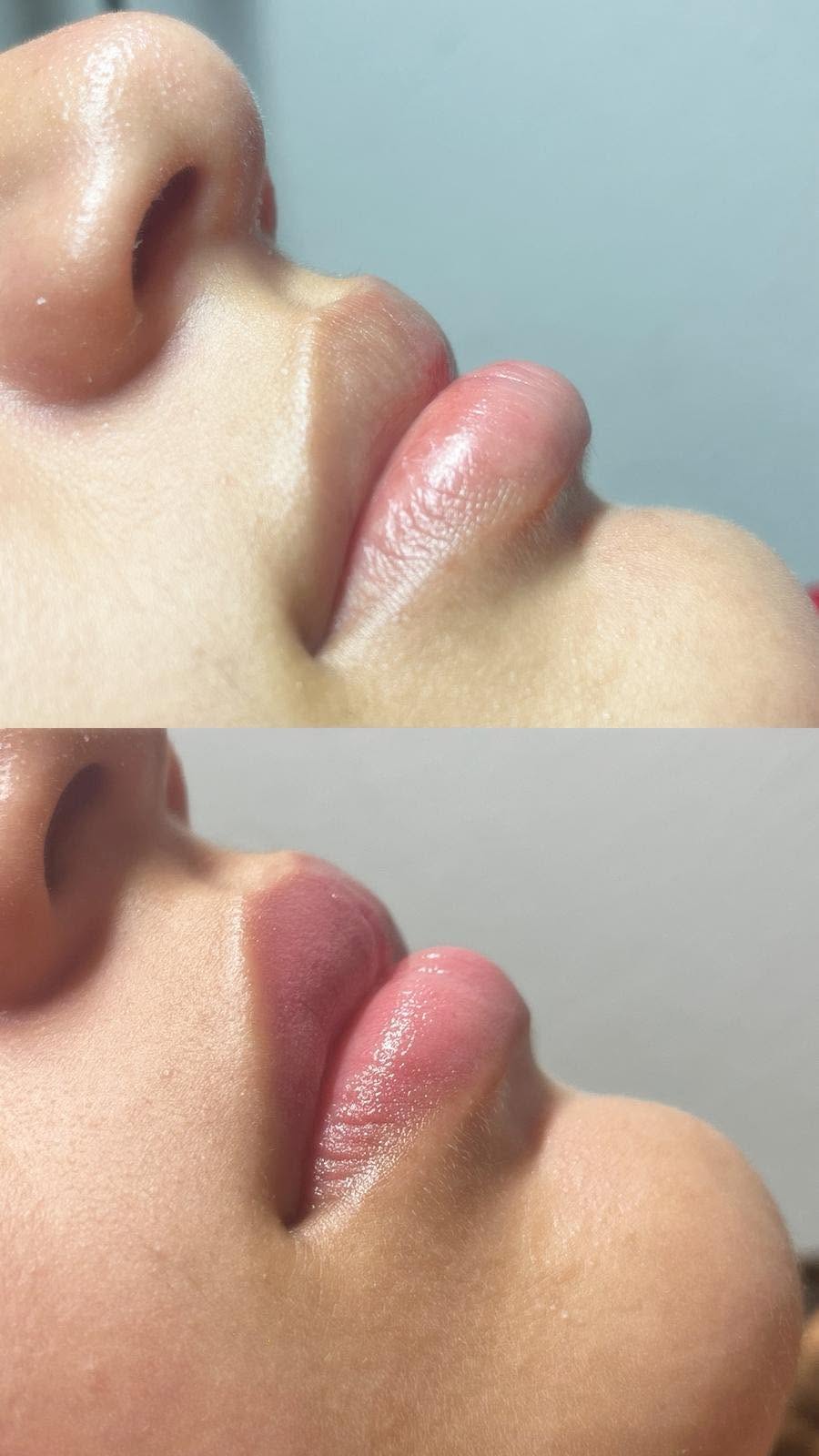 Resultado antes y después de tratamiento de labios